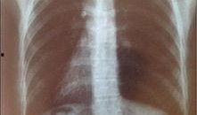 胸片爆料2024年最新,透视健康趋势与疾病预警